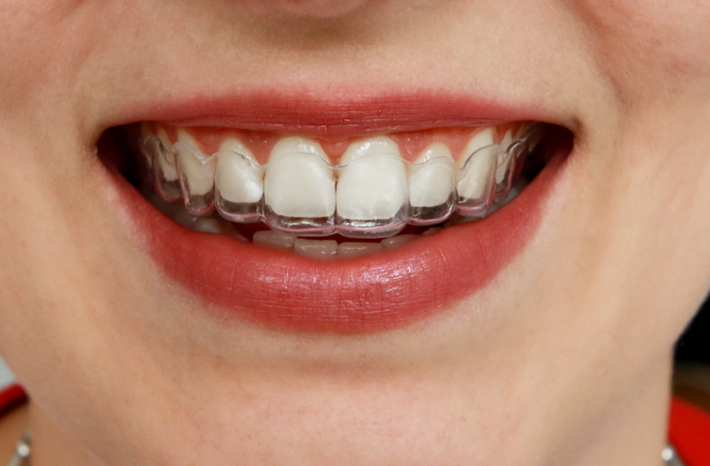 Aligner-Schiene Aligner-Schiene